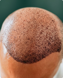 Pós implante capilar